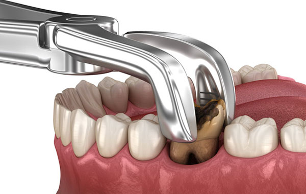 Современное оборудование и опыт наших врачей позволяет быстро и безболезненно удалить зубы  