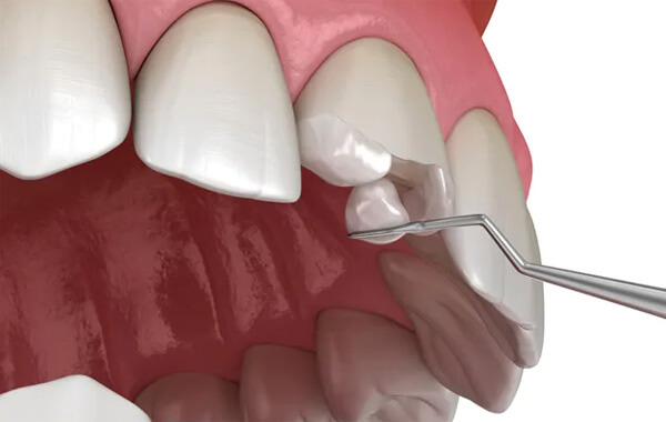 Восстанавливаем природную форму зубов и их цветовую структуру
